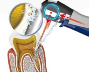 Ultrasonidos Vector (R) tratamiento periodontal