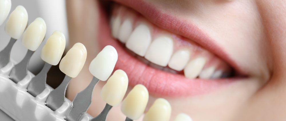 Clínica Dental Agulló y Vilaró - Dentista de Confianza en Tenerife Adeje - Funda Dental - Carilla Dental